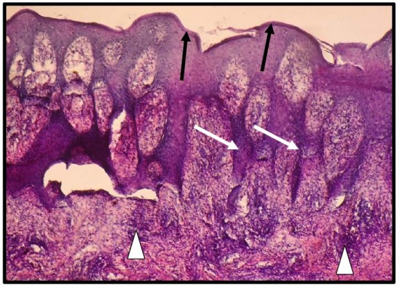 Figure 3 : Photomicrograph of skin tissue from Group II showeddegenerative changes of the sweat gland (black arrow) surrounded by prominent deposition of lymphocytes (white arrow)(H&E X150).