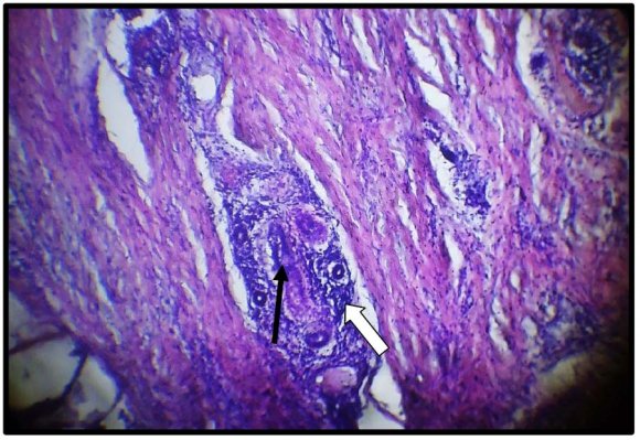 Figure 4 : Photomicrograph of skin tissue from Group II showed congestion of the blood vessels in the dermis(black arrow) with obvious perivascular lymphocytic infiltration (white arrows)(H&E X100).