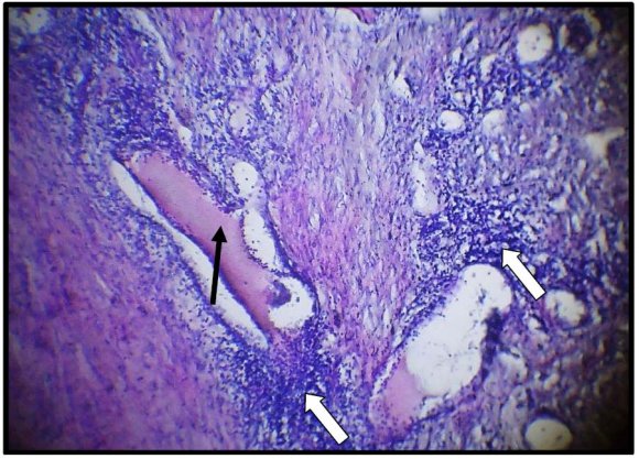 Figure 5 : Photomicrograph of skin tissue from Group II showeddisturbance of the histological architecture with focal areas of necrosis (black arrow)(H&E X100).