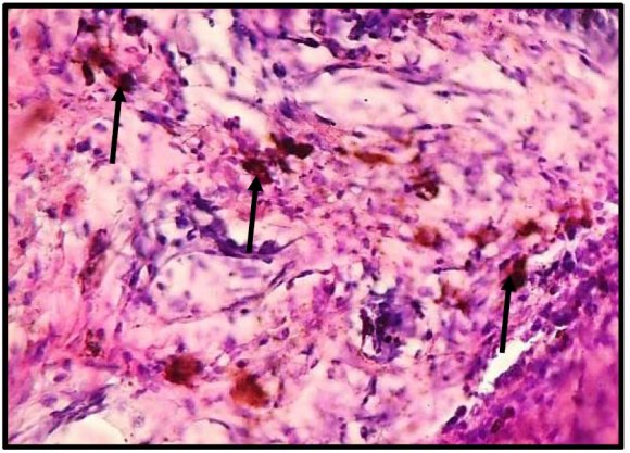 Figure 9 : Photomicrograph of skin tissue from Group III showedmarked hyperkeratosis as thickened keratin covering the epidermis (black arrow)with sever acanthosis (white arrows)(H&E X100).