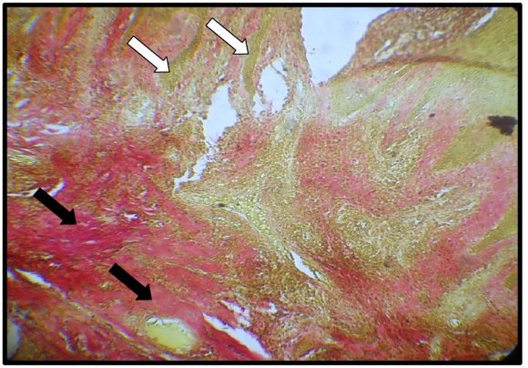 Figure 11 : Photomicrograph of skin tissue from Group III showeddilated acini of the sweat glands with degenerative changes of their lining epithelium (black arrows) and dilatation of their ducts (white arrow)(H&E X150).