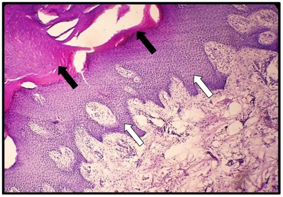 The Histological Changes of the Skin Lesion in Diabetic Foot