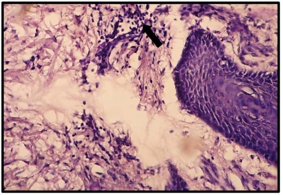 Figure 12 : Photomicrograph of skin tissue from Group III showedvacuolar degeneration of Schwann cells of the peripheral nerve(black arrows)(H&E X400).