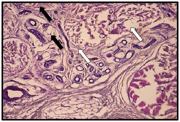 The Histological Changes of the Skin Lesion in Diabetic Foot