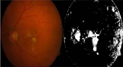 Fig. 1 : Typical CT images for brain lesions in AIDS complication patients A-D: Typical CT images for brain lesions in AIDS complications, including TBM, CM, HIVE and CT among 65 AIDS patients. A1-D1: The bar charts depict the incidences of brain lesions in AIDS complications, including TBM, CM, HIVE and CT, respectively. Abbreviations: TBM: tuberculous meningitis; CM: cryptococcal meningitis; HIVE: HIV encephalitis; and CT: cerebral toxoplasmosis.