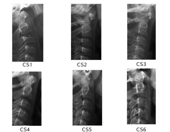 Figure 3 : linear relationship among chronological and dental age.