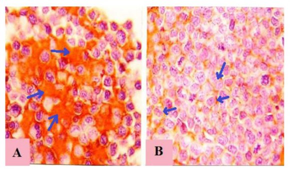 Figure 4: The ethanol extract of combination of Punica grantum L and Ziziphus mauritiana developed DNA fragmentation in Ehrlich ascites carcinoma comparable to the effect of 5-Fluorouracil. 5-FU (5-Fluorouracil), Control (untreated EAC), ZP(E) (Ethanol extract of combination of Punica grantum L and Ziziphus mauritiana).