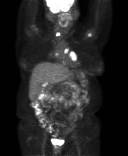 Figure 1: Initial CT at the level of the left hilum showed large left hilar mass 3.9x3.5x4.9cm in her left lung. Left lower lobe mass was 2.4cmx2.9cm and multiple nodules were seen on the left. A lytic lesion was seen in the humeral head.