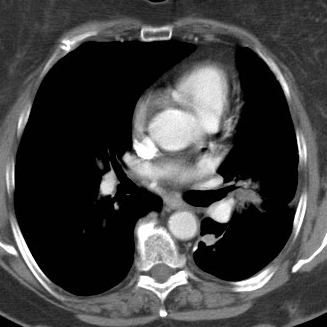 Figure 2: Pet CT showed multiple hypermetabolic masses at the left lung, the largest at the left lower lobe perihilar region with SUV 15.8; hilar mass; metabolic activity within the right thyroid nodule; destructive metastatic lesion in the left humeral head.