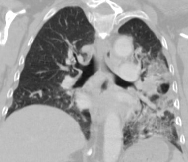 Figure3: Two weeks following the beginning Erlotinib treatment (4 weeks following radiation therapy), she reported a dry cough and dyspnea on exertion. Her pulse ox dropped to 92% after ambulation. A CT scan showed smaller masses and scarring in the left lower lobe in the area of surgery. The majority of the pleural-based nodules that were present on prior examination were no longer seen.