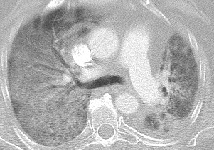 Figure4: Approximately one month later, she reported increased SOB without hemoptysis, fevers, or chills. Repeat CT scan showed smaller masses, but new left lung infiltrates and an area of consolidation in the left lung that vaguely outlined the radiation port. There was an associated left pleural effusion.
