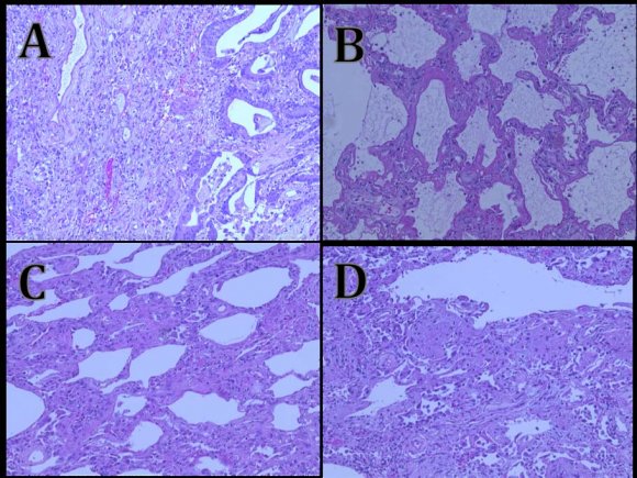 Figure 5: Repeat axial enhanced CT chest revealed bilateral diffuse pneumomediastinum with posterior displacement of the heart, and worsening airspaces, sparing the apices. The patient was severely dyspneic as evident by respiratory motion. Blood gas: pH 7.38, pc02 56, and o2 sat of 86%. Her disease progressed and the patient expired under comfort measures.