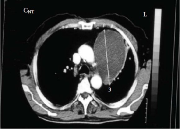 Figure 1: A well-circumscribed mass in the middle lung field.
