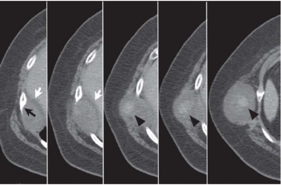 Figure 2: Computed tomography shows a homogeneous cystic mass at the costosternal junction.