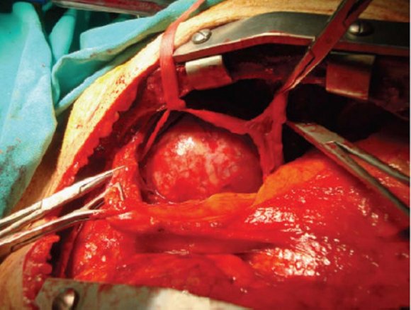 Figure 3: Axial post-contrast CT revealing the inner component of the mass compressing the liver and bulges through the intercostal space into the outer thoracic wall. The tumor erodes the adjacent inferior margin of the 9th rib (black arrow) and shows central enhancement (black arrowheads).