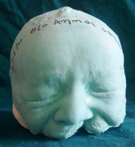 Figure 1: Use of the specialized impression tray for facial moulage in an infant with complete unilateral cleft lip and palate.
