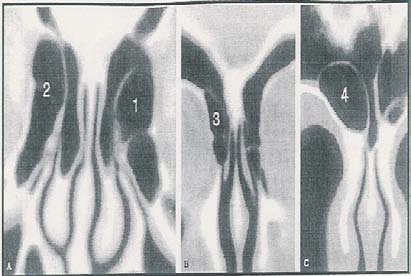 Figure 3: MRP expression as a percentage of SED-SAL in SOL. Data are mean ± SD. SOL, soleus; SED, sedentary; WR, wheel-run; SAL, saline-treated; DOX, doxorubicin-treated. Interaction in MRP-7 (p<0.05).