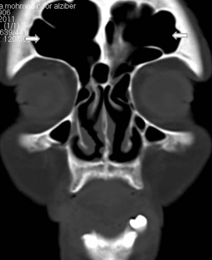 Computed Tomography-Aided Clinical Report on Anatomical Variations of the Paranasal Sinuses