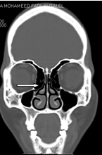 Figure 1: Variable pneumatization of the Figure 2: Coronal views of frontal cells frontal sinuses as shown in coronal (four types)