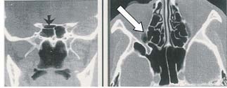 Figure 3: Ethmoidal bulla delineated Figure 4: Posterior ethmodi cell shown in both by coronal scan coronal and axil section [Black and white arrows]