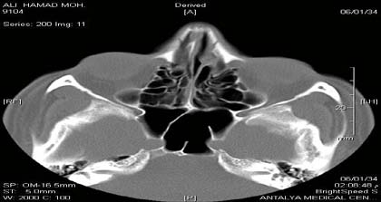 Figure 9: Maxillary sinus right unilateral