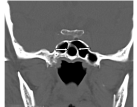 Figure 7: Septation of the sphenoidal sinus Figure 8: Anatomical variations of maxillary sinus
