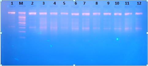Figure 1: Computed tomography (CT) scan of abdomen reveals right adrenal mass which proved to be estrogen secreting abdomen.