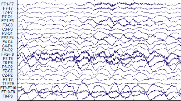 Towards Automated Epileptic Seizure Detection for Lightweight Devices through EEG Signal Processing