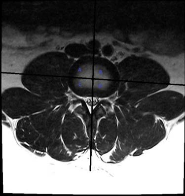 Figure 1: TSE T2W axial image at the level of L4-L5 showing bilateral complete attachment of the psoas major muscle to the intervertebral disc in the four quadrants divided by drawing two perpendicular lines at the center of the disc. A: Right anterolateral; B: Left anterolateral; C: Right posterior; D: Left posterior