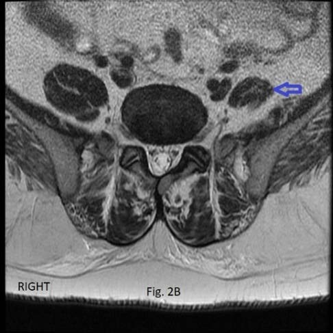Figure 3: TSE T2W axial image at L5-S1 level showing nonattachment of the psoas major muscle to the disc associated with a circumferential disc herniation (arrows).