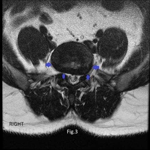 Figure 4: TSE T2W axial image at L4-L5 level showing complete attachment of the psoas major muscle to the disc on the right side. There is partial attachment of the psoas major muscle to the disc on the left side (curved arrow) with absence of muscle fiber attachment in left posterior quadrant. A central and left posterolateral disc herniation is noted (arrows).