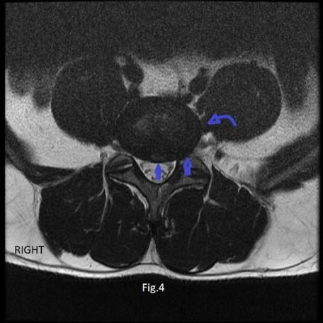 Prevalence and distribution of the three common patterns of disc herniation at the three levels L3-L4, L4-L5 and L5
