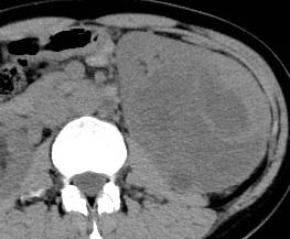 Figure 1: (a) Pre-contrast, (b) Corticomedullary,(c) Nephrographic, (d) Excretory phase-A case of clear cell renal carcinoma in a 49 years old female measuring 8 cm in diameter showing hyperdense, heterogeneous enhancement with internal necrosis (arrow).