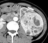 Figure 2: (a) Pre-contrast, (b) Corticomedullary phase,(c) Nephrographic phase : A case of papillary renal cell carcinoma in a 43 years old male, measuring 7cm in diameter showing calcification (arrow), necrosis and heterogeneous enhancement pattern.