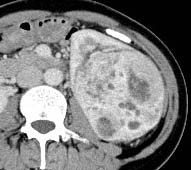 Figure 3: (a) Pre-contrast phase, (b) Corticomedullary phase, (c) Nephrographic phase, (d) Excretory phase of a case of chromophobe cell renal carcinoma in 47 years old male measuring 5.5cm in daimeter showing hypovascular heterogeneous enhanced pattern with necrosis (arrow)