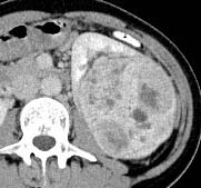 Figure 4: (a) Pre-contrast, (b) Corticomedullary, (c) Nephrographic, (d) Excretory phase -A case of clear cell renal carcinoma in a 32 years old male measuring 1 cm in diameter showing hypodensity after contrast adminstration.