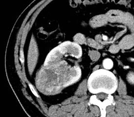 Differences in Contrast-Enhanced CT Features between Clear Cell Renal Carcinoma and Non-Clear Cell Renal Carcinoma