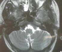 Figure 1: Lymph node showing sub-capsular and deeper deposits of poorly differentiated adenocarcinoma.