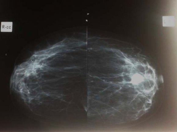 Figure 1: Mammographie cliché de profil et de facedu sein gauche montrant une opacité dense arrondie rétroaréolaire du sein gauche
