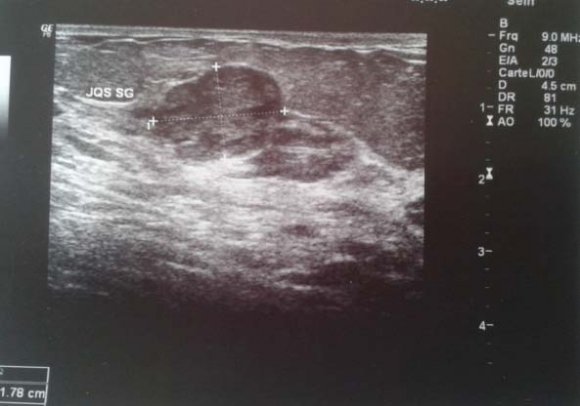 Figure 5: Mammographie cliché de profil et de face montrant une opacité floue, arrondie spiculéerétroaréolaire du sein droit