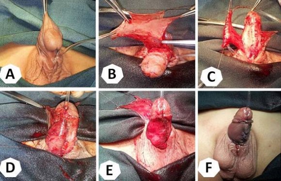Conclusions: The results of renal transplantation indicate the possibility of prolonged rehabilitation including high risk patients. The later improvement is related to expanding of I. Introduction onetsk Transplant Center performed 705 operations since the first renal transplantation on 17 April 1986 till October 2016. The study summarizes the experience of organizational, clinical, scientific and educational work of the Centre in order to identify further priorities for professionals.