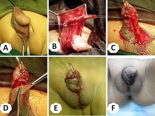 Figure 1: Transverse preputial island onlay tube (Duckett). A, Penoscrotal hypospadias with severe chordae. B, The flap is dissected from dorsal skin. C, The flap is tubed around the stent. D, the tube is transferred ventrally and anastomosed to the native urethra. E, The dorsal skin is ready to be brought ventrally to the base of the flap. F, The repair is completed.