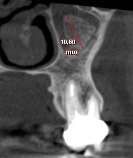 Tomograpphy Study of Intra-Sinus Calcifications