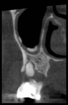 Fig.1: Three calcifications in the left maxillary sinus