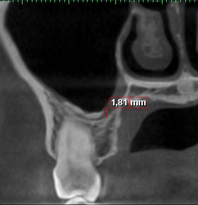 Fig. 4: Intra-sinus calcification of nodular shape