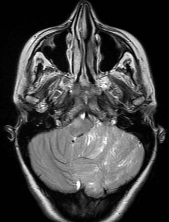 al, 2012). Such atypical Volume XVII Issue I Version I in this patient in the form of multiple cortical and subcortical hypodensities in the right frontal and parietal lobes, with multiple haemorrhagic foci in the right frontal lobe and right basal ganglia.
