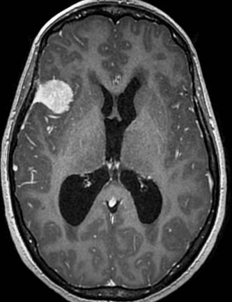Figure 2B: Axial ADC map showing high ADC signal in the parietal lobes indicating vasogenic oedema