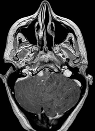 Figure 1A: Axial T2-weighted magnetic resonance imaging of the brain showing the left cerebellar mass with widened cerebellar folia, a striated pattern, and preserved cortex. Note the retroclivaldural-based isointense mass on the right side representing retroclival meningioma.