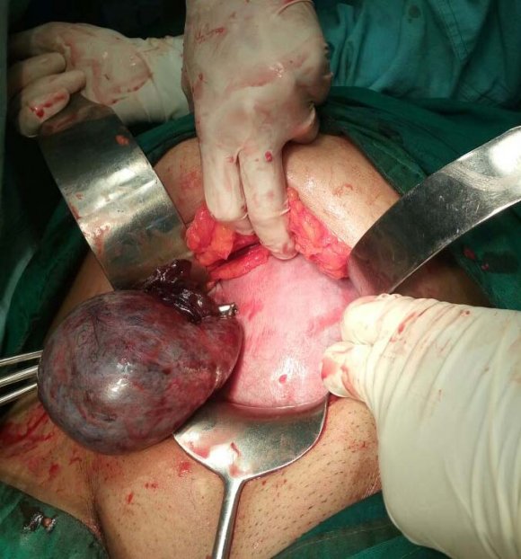 Figure 1: Twisted rt ovarian cyst with 26 wks pregnant uterus.