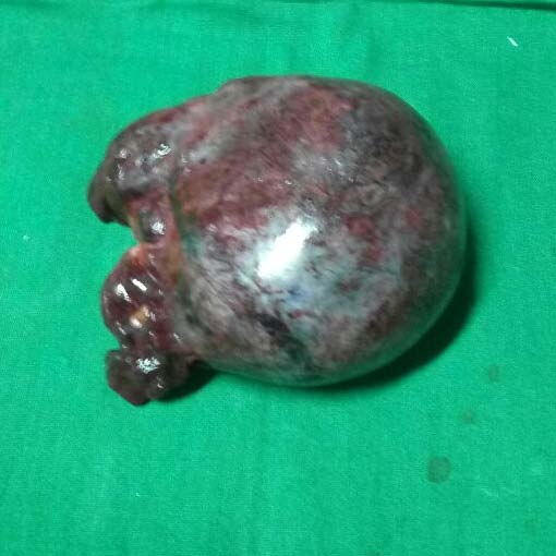 Figure 2: Specimen of 10 x 8 cm twisted rt ovarian cyst.